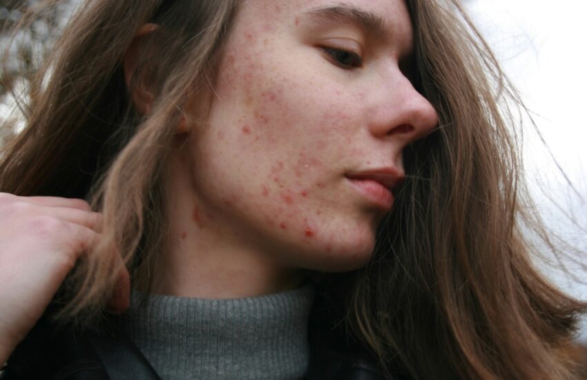 tips tegen acne